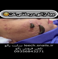 زالودرمانی جوش صورت و پشت گوش Leech therapy