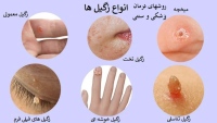 انواع زگیل و روشهای درمان پزشکی و سنتی آن