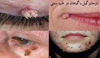 درمان زگیل با گیاهان در طب سنتی